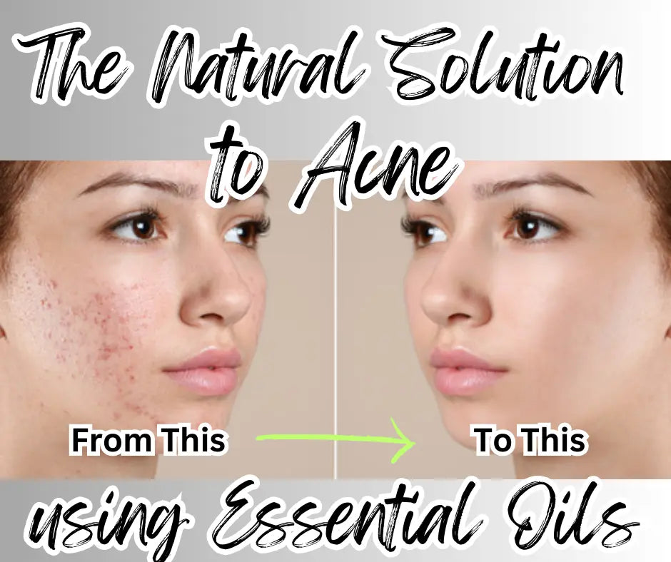 The-Natural-Solution-to-Acne-Harnessing-the-Power-of-Essential-Oils Northridge Oak
