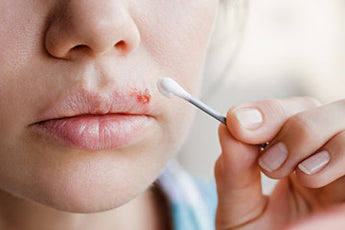 Essential Oils: Your Natural Ticket to Kiss Cold Sores Goodbye